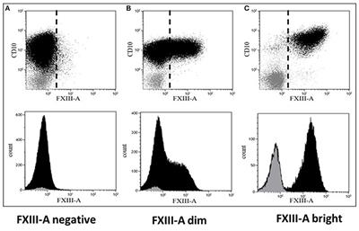 Coagulation FXIII-A Protein Expression Defines Three Novel Sub-populations in Pediatric B-Cell Progenitor Acute Lymphoblastic Leukemia Characterized by Distinct Gene Expression Signatures